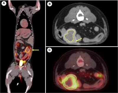 Case report:18F-2-deoxy-2-fluoro-D-glucose positron emission tomography/computed tomography image findings of a dog with gossypiboma